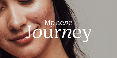 My acne journey