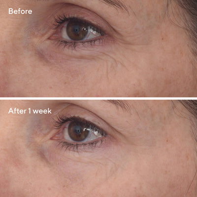 Retinal ReSculpt Eye Lift Treatment