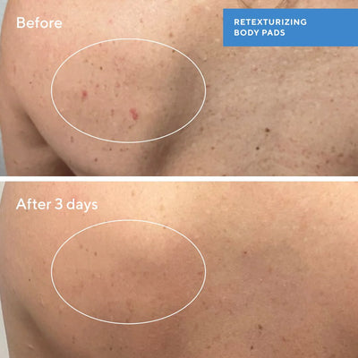 Retexturizing Body Pads