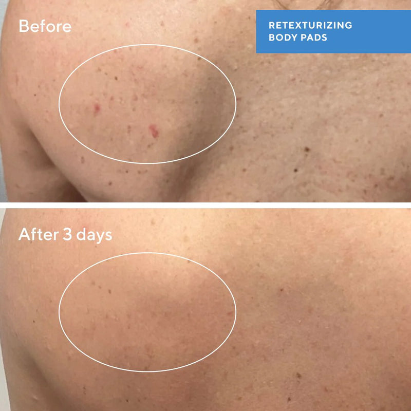 Retexturizing Body Pads