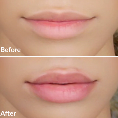 PMD Kiss Lip Plumping System Pink Anti-Aging Lip Enhancing Treatment