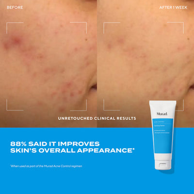 Acne Control Clarifying Cleanser